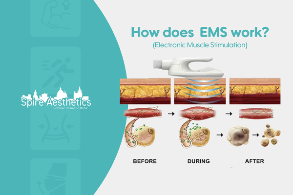 EMS treatment for post pregnancy weight loss treatment Chapeltown