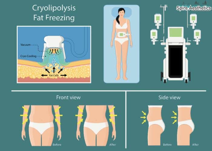 Image of diet and fat freezing combined for best results for Spire Aesthetics Chapeltown