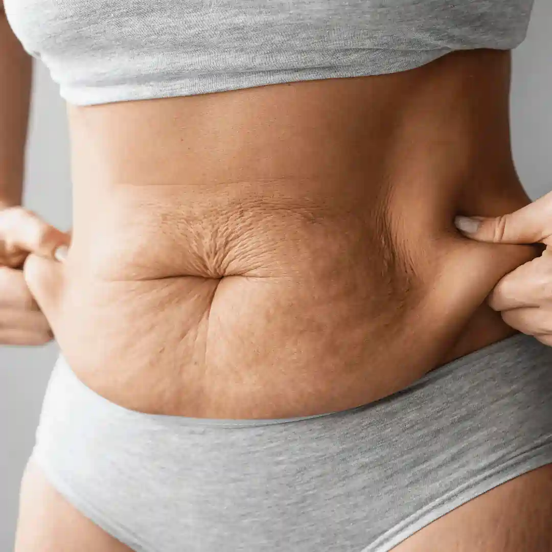 Is It Normal to Have Loose Skin After Pregnancy Chapeltown?